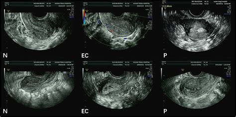 thick endometrial lining positive pregnancy test|endometrial thickness iup prediction.